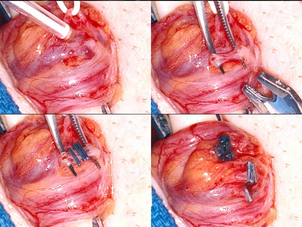 Varicocelectomy